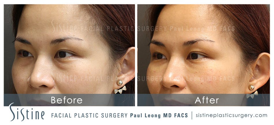 Restylane Juvederm Before and After | Leong Facial Plastic Surgery
