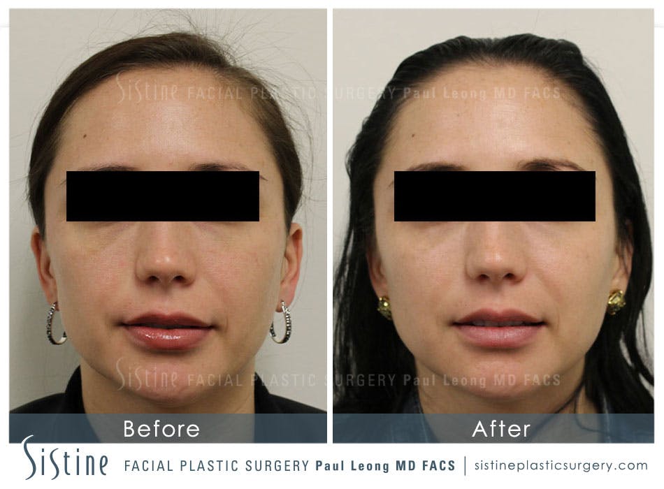 Restylane Juvederm Before and After | Leong Facial Plastic Surgery