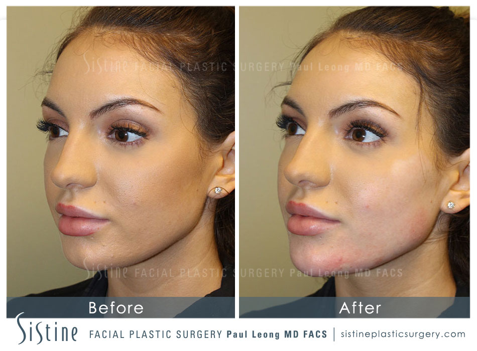 Restylane Juvederm Before and After 61 | Leong Facial Plastic Surgery