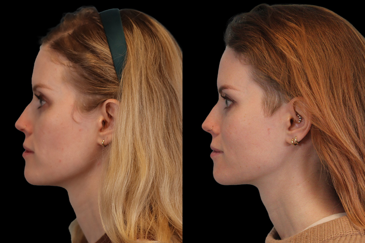 Sculptra Before and After | Leong Facial Plastic Surgery