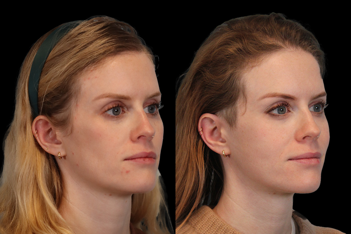 Sculptra Before and After | Leong Facial Plastic Surgery