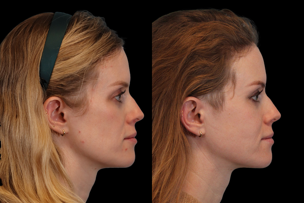 Sculptra Before and After | Leong Facial Plastic Surgery