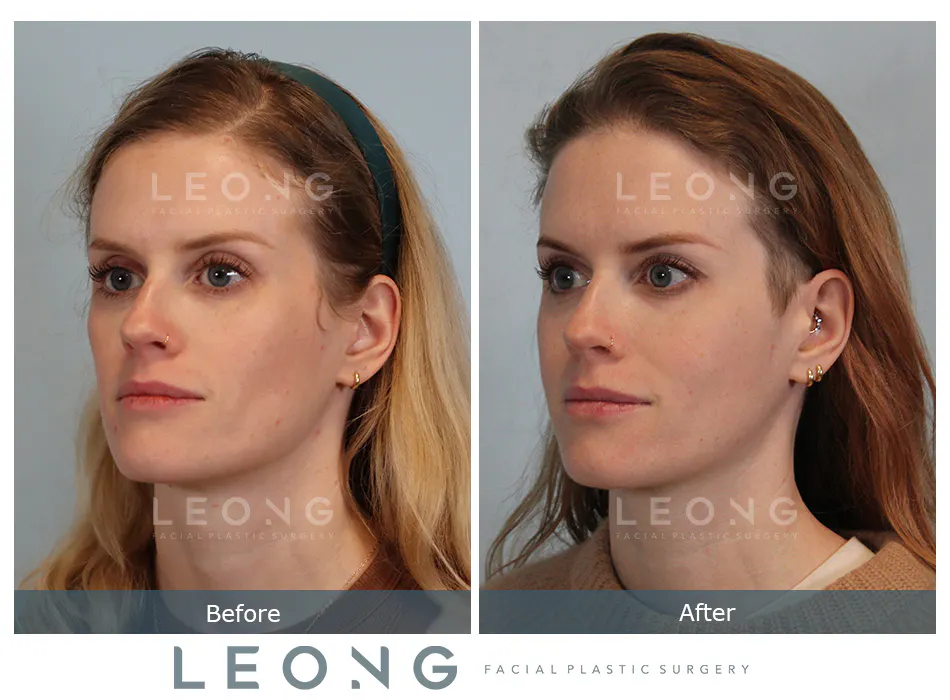 Sculptra Before and After | Leong Facial Plastic Surgery