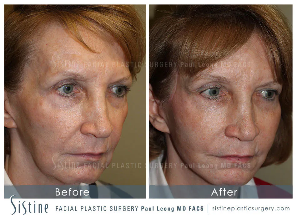 Sculptra Before and After | Leong Facial Plastic Surgery