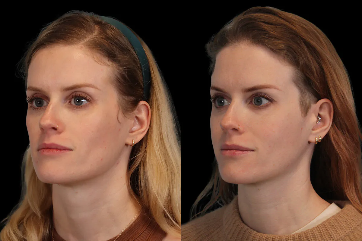 Sculptra Before and After | Leong Facial Plastic Surgery