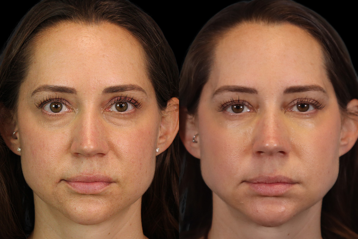 Tear Trough Correction Before and After | Leong Facial Plastic Surgery