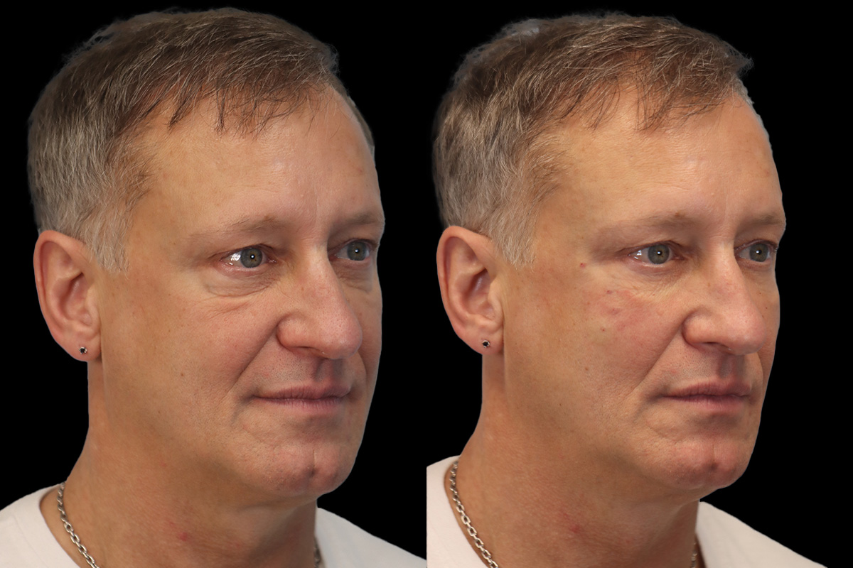 Tear Trough Correction Before and After | Leong Facial Plastic Surgery