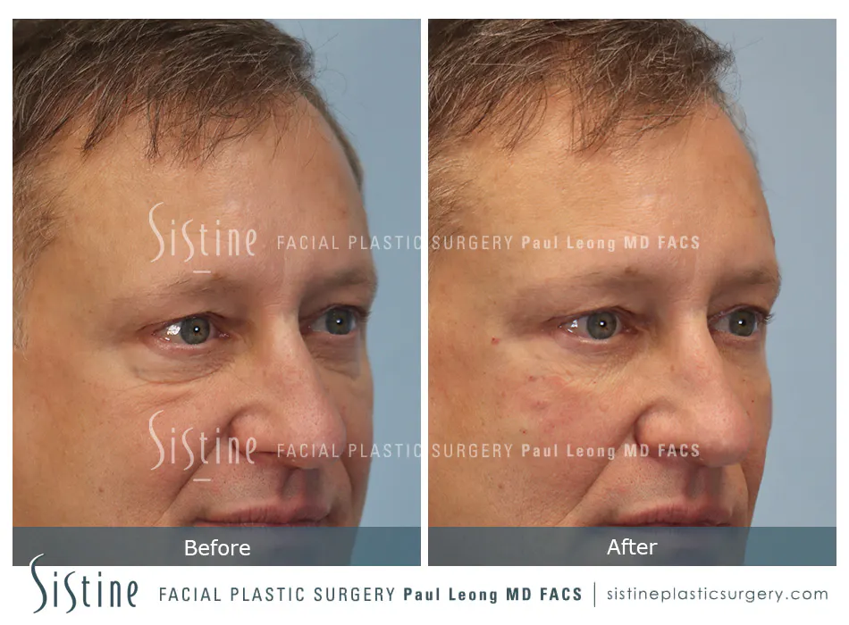 Tear Trough Correction Before and After | Leong Facial Plastic Surgery