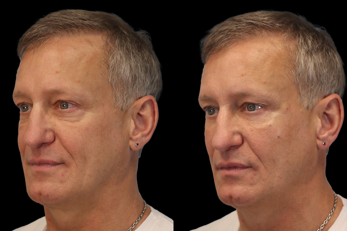 Tear Trough Correction Before and After | Leong Facial Plastic Surgery