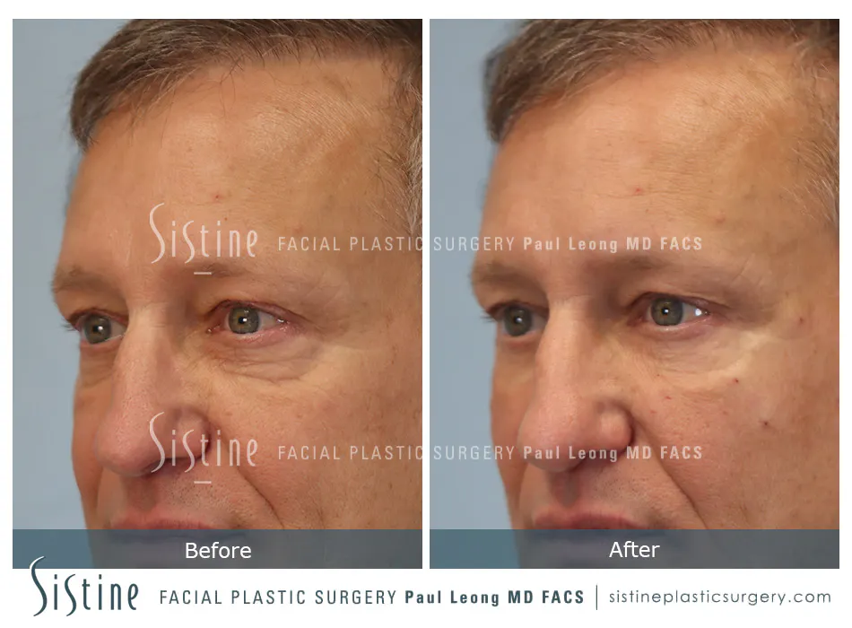 Tear Trough Correction Before and After | Leong Facial Plastic Surgery