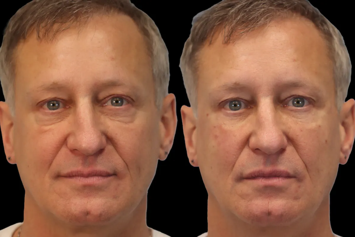 Tear Trough Correction Before and After | Leong Facial Plastic Surgery