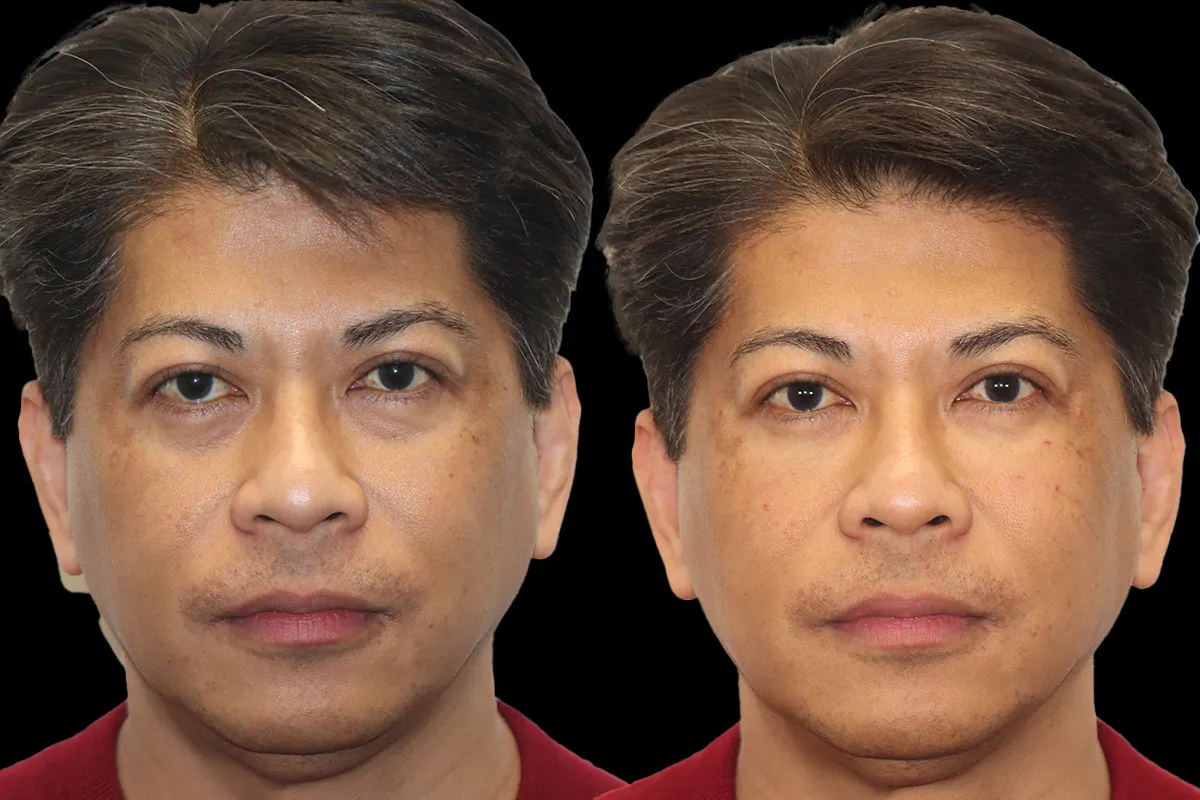 Tear Trough Correction Before and After | Leong Facial Plastic Surgery