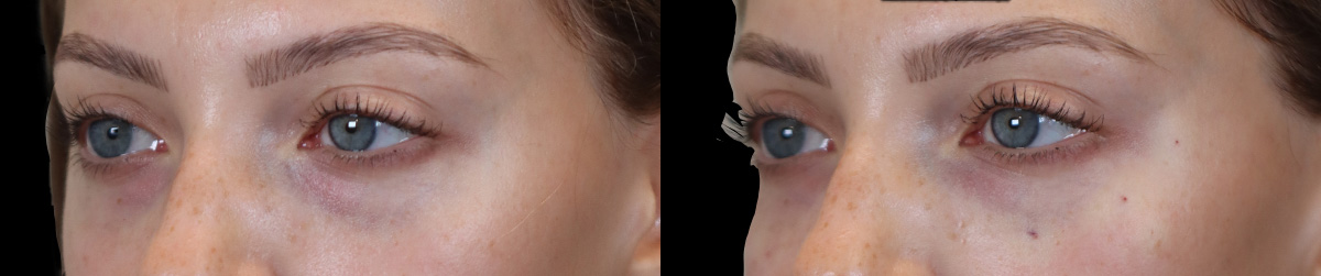 Tear Trough Correction Before and After | Leong Facial Plastic Surgery