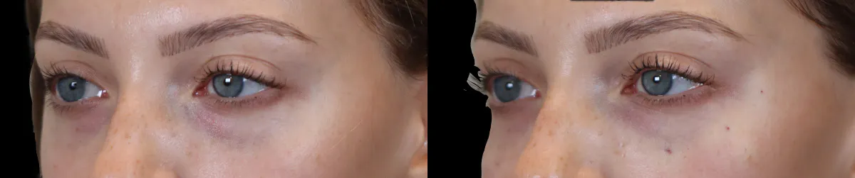 Tear Trough Correction Before and After | Leong Facial Plastic Surgery
