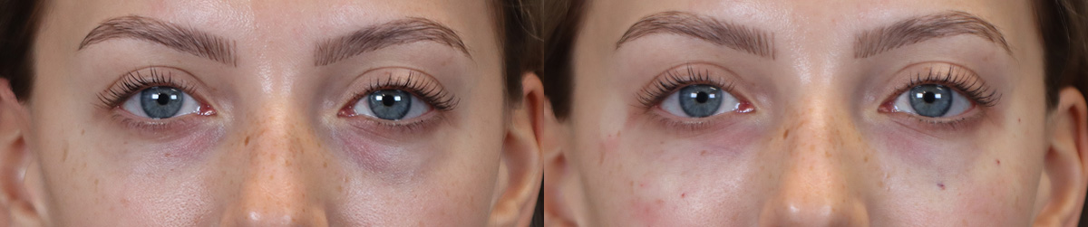 Tear Trough Correction Before and After | Leong Facial Plastic Surgery