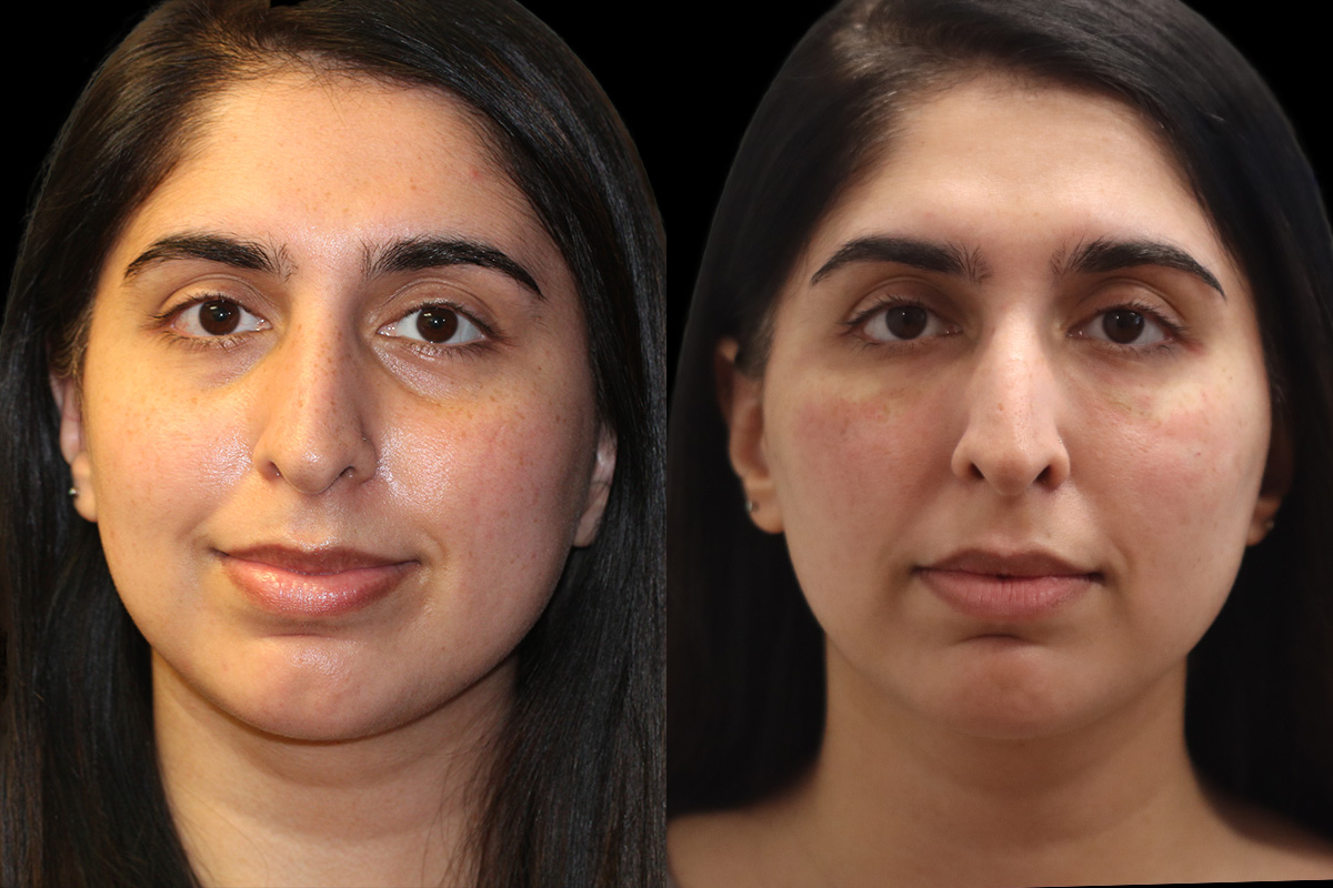 Tear Trough Correction Before and After | Leong Facial Plastic Surgery