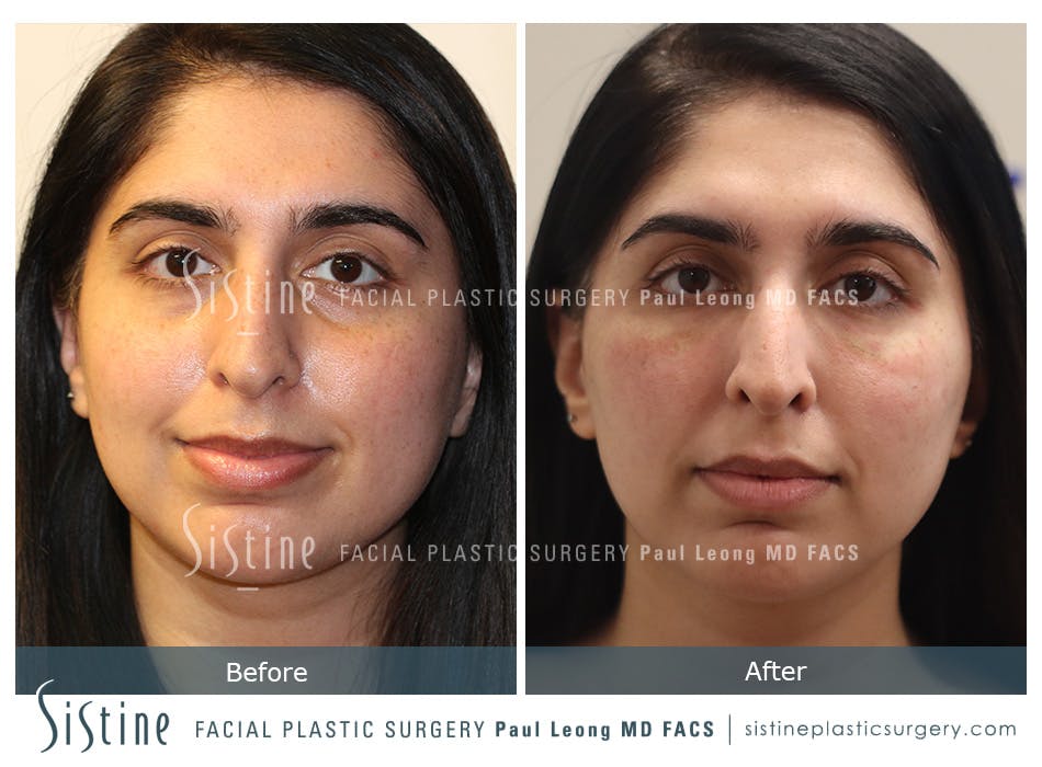 Tear Trough Correction Before and After | Leong Facial Plastic Surgery
