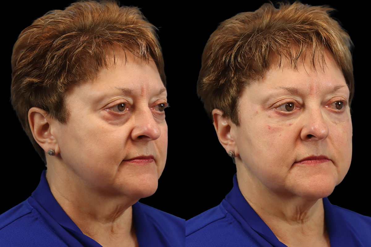 Tear Trough Correction Before and After | Leong Facial Plastic Surgery