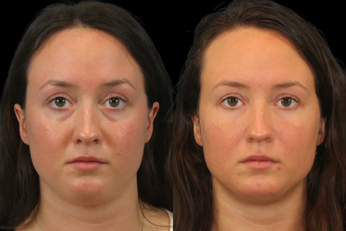 Tear Trough Correction Before and After | Leong Facial Plastic Surgery