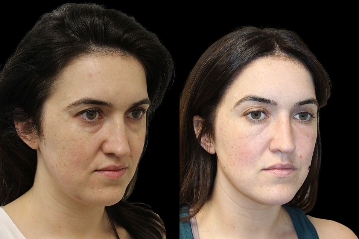 Tear Trough Correction Before and After | Leong Facial Plastic Surgery