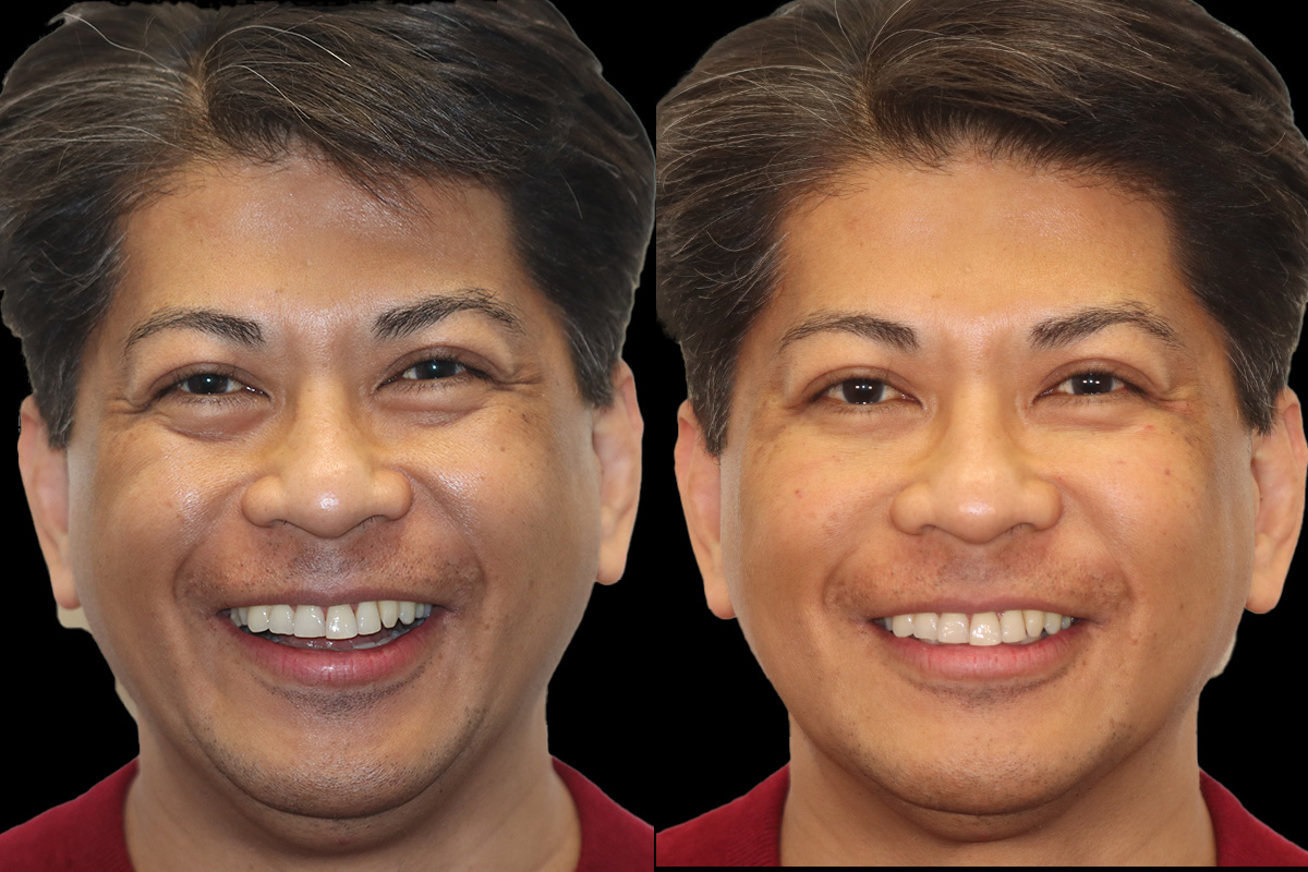 Tear Trough Correction Before and After | Leong Facial Plastic Surgery
