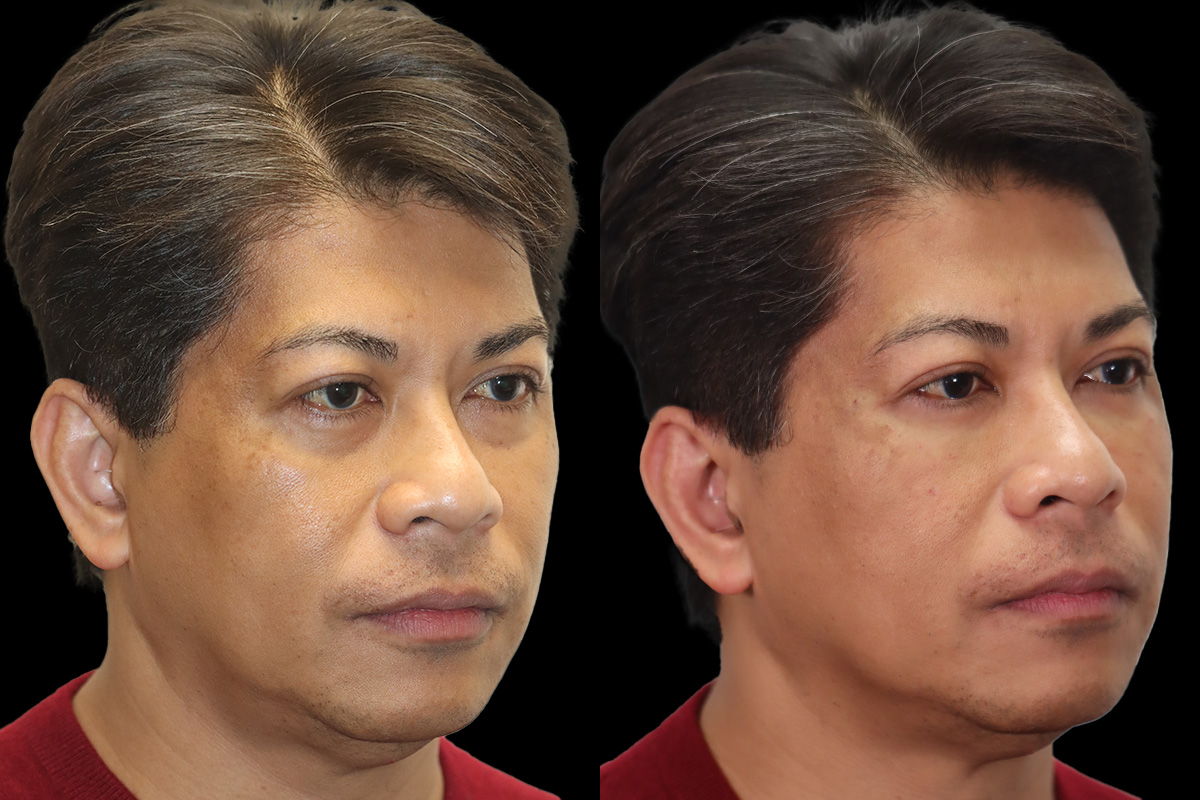 Tear Trough Correction Before and After | Leong Facial Plastic Surgery