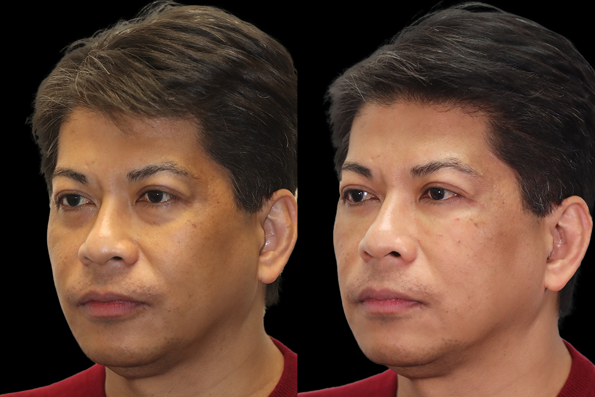 Tear Trough Correction Before and After | Leong Facial Plastic Surgery