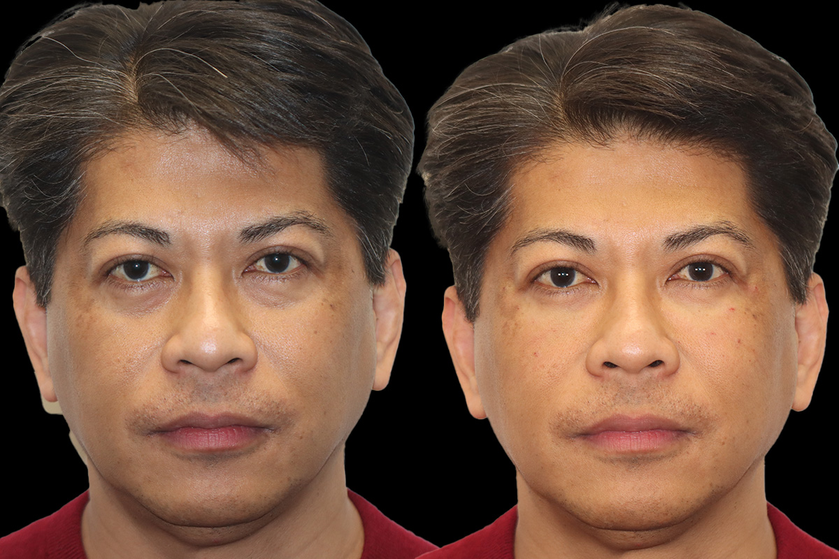 Tear Trough Correction Before and After | Leong Facial Plastic Surgery