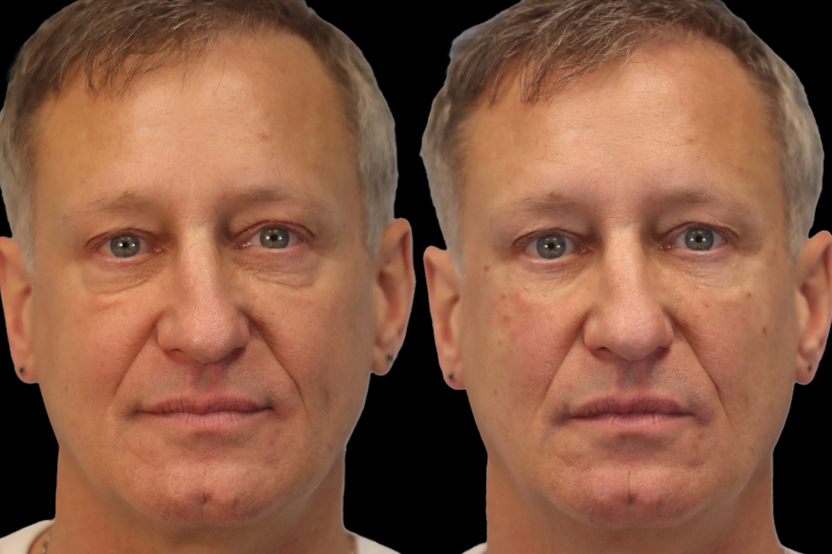Tear Trough Correction Before and After | Leong Facial Plastic Surgery