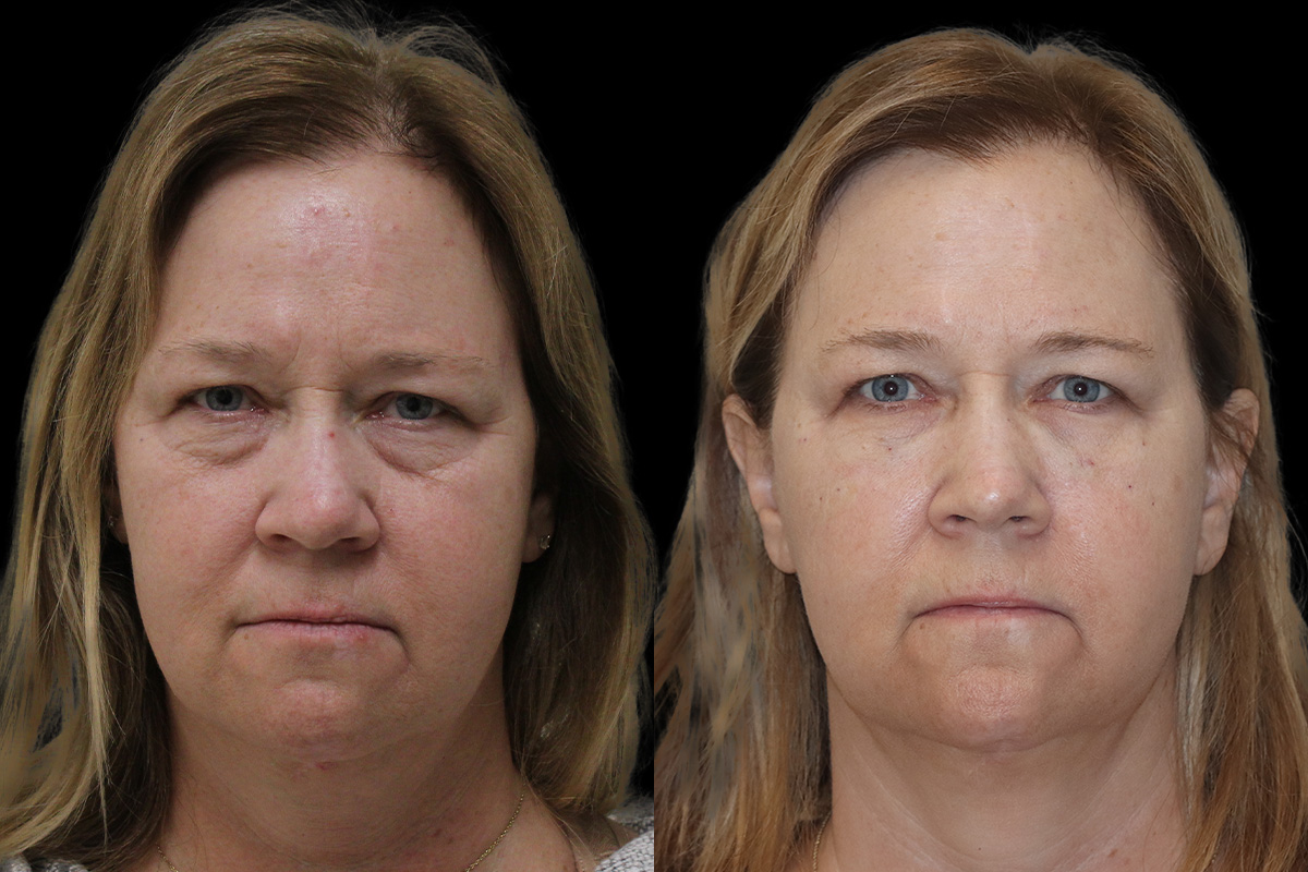 Tear Trough Correction Before and After | Leong Facial Plastic Surgery