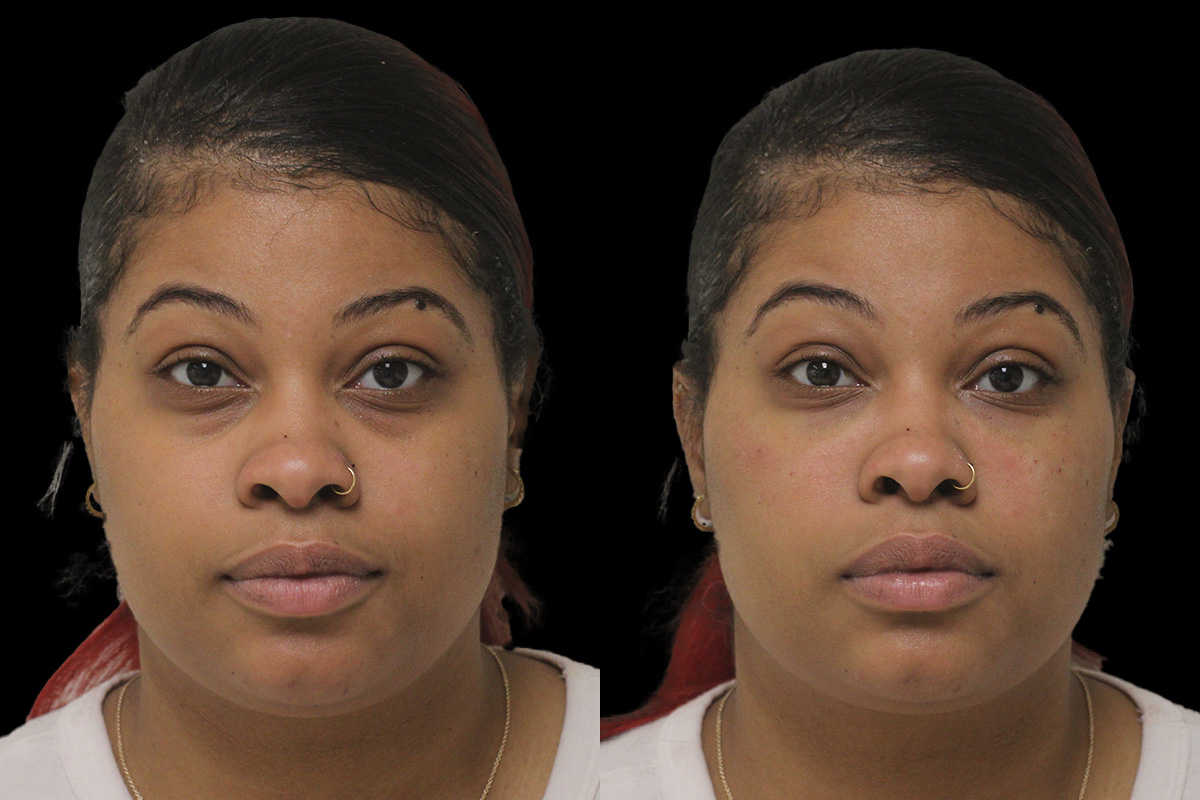Tear Trough Correction Before and After | Leong Facial Plastic Surgery