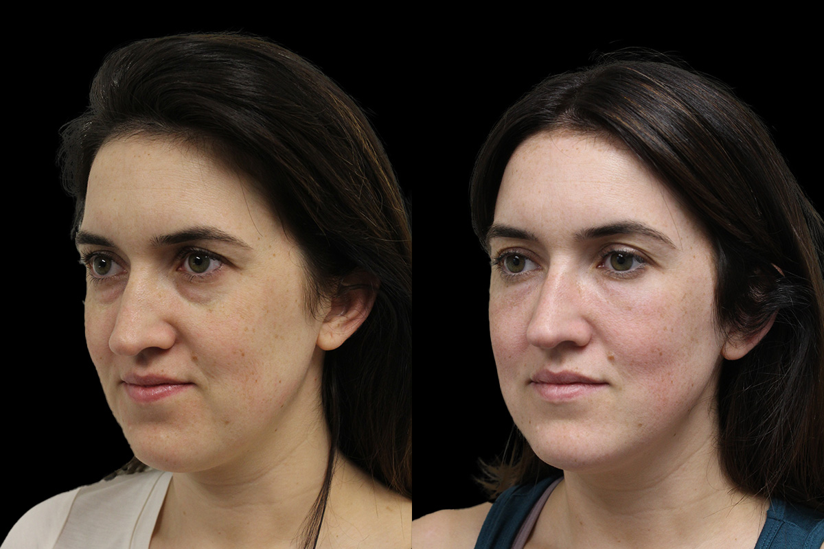 Tear Trough Correction Before and After | Leong Facial Plastic Surgery