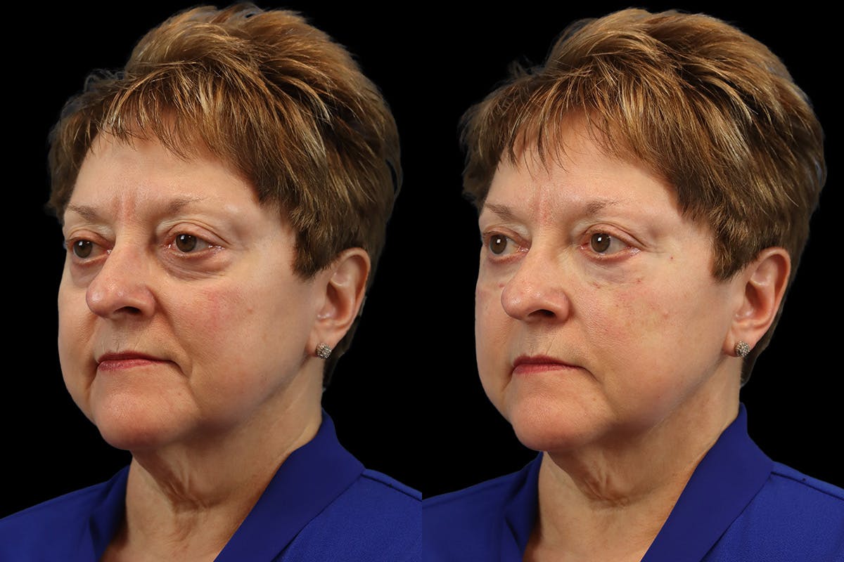 Tear Trough Correction Before and After | Leong Facial Plastic Surgery