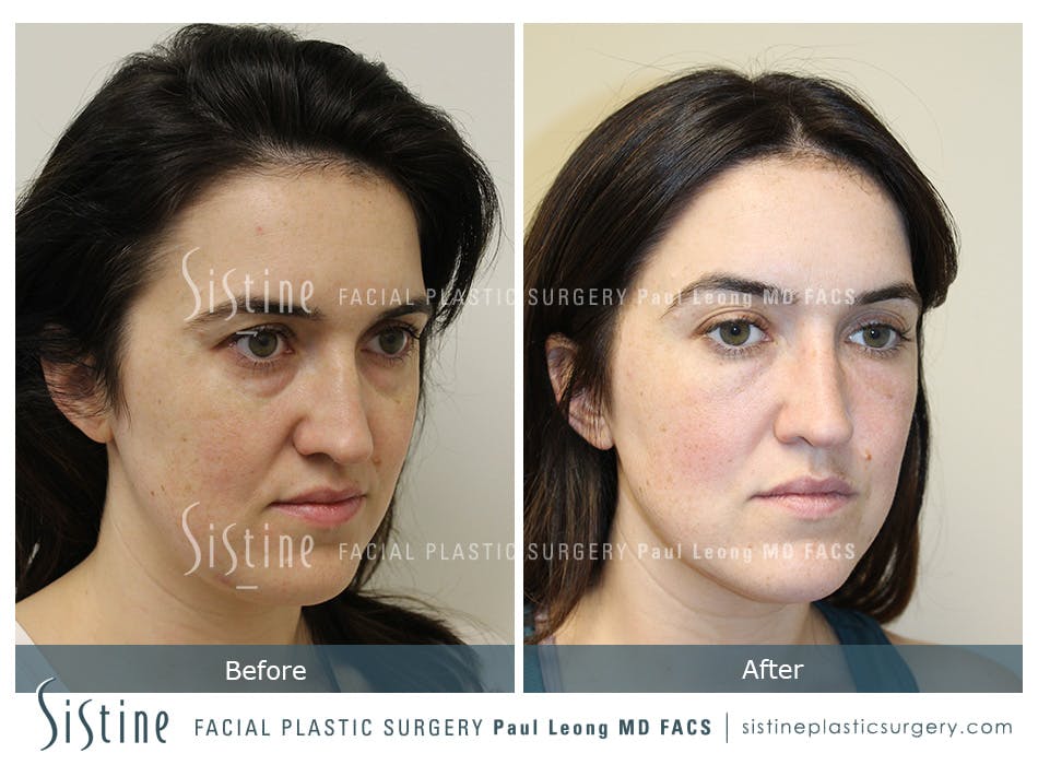 Tear Trough Correction Before and After | Leong Facial Plastic Surgery