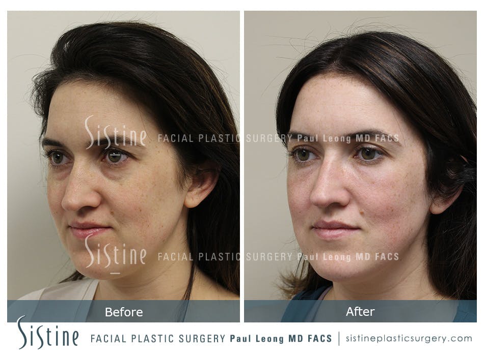 Tear Trough Correction Before and After | Leong Facial Plastic Surgery