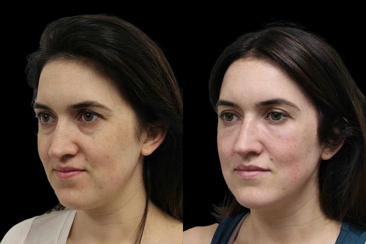 Tear Trough Correction Before and After | Leong Facial Plastic Surgery