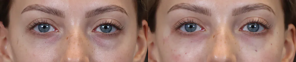 Tear Trough Correction Before and After | Leong Facial Plastic Surgery