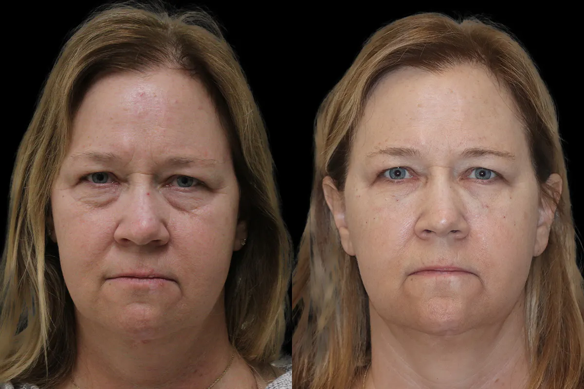 Tear Trough Correction Before and After | Leong Facial Plastic Surgery
