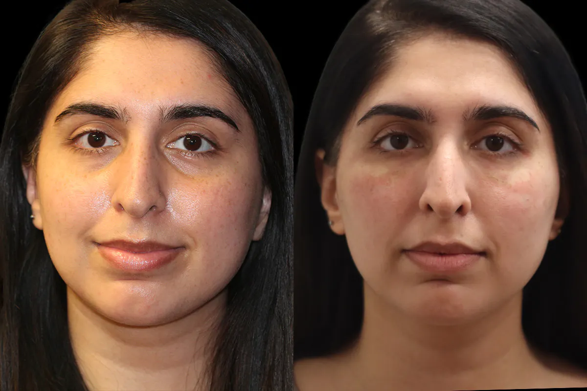 Tear Trough Correction Before and After | Leong Facial Plastic Surgery