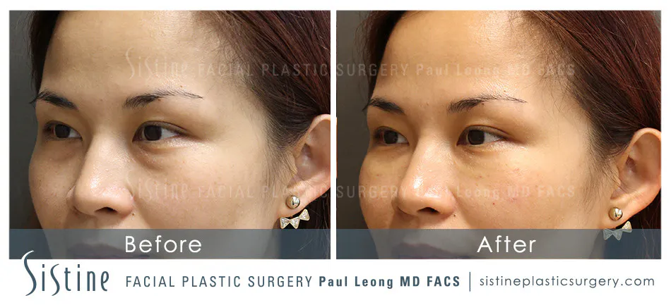 Tear Trough Correction Before and After | Leong Facial Plastic Surgery