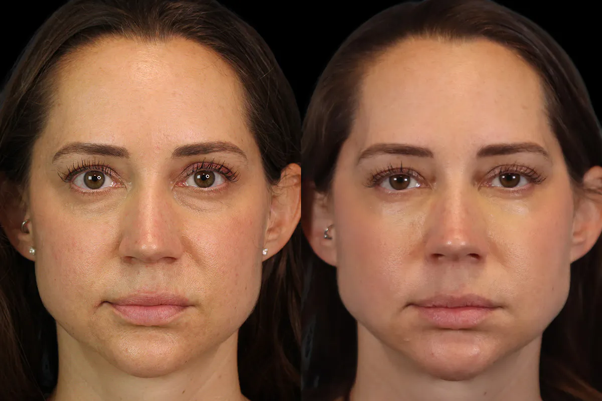 Tear Trough Correction Before and After | Leong Facial Plastic Surgery