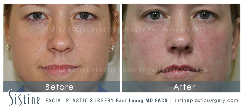 Tear Trough Correction Before and After | Leong Facial Plastic Surgery