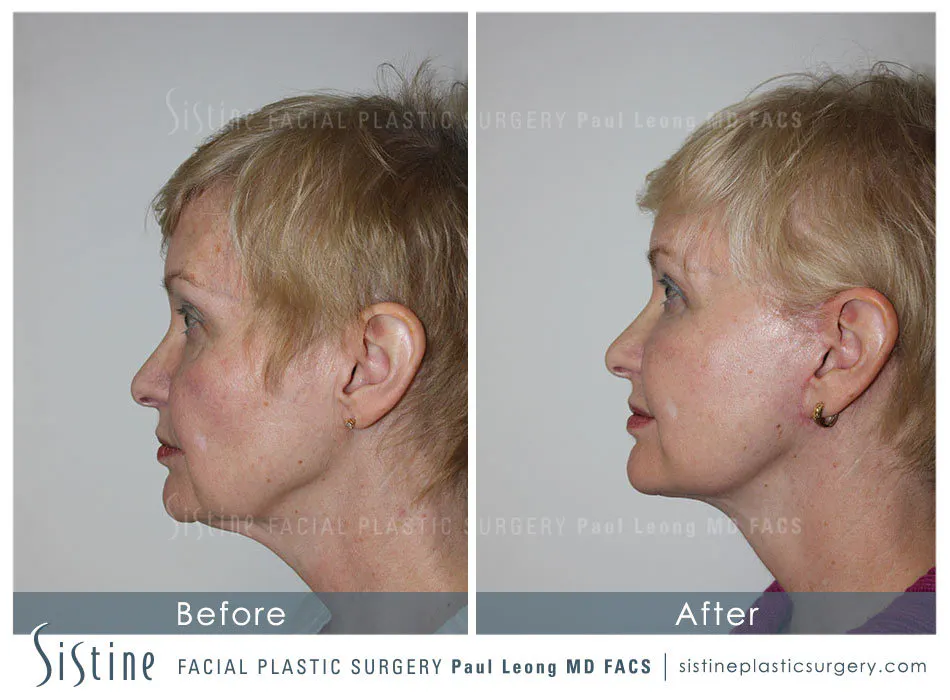 Tear Trough Correction Before and After | Leong Facial Plastic Surgery