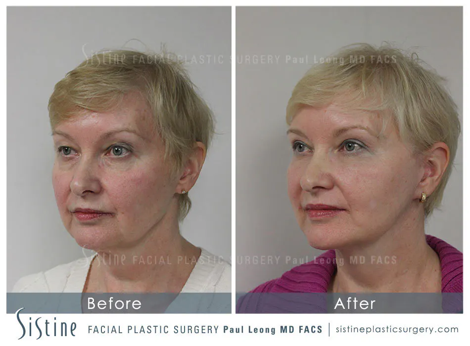 Tear Trough Correction Before and After | Leong Facial Plastic Surgery