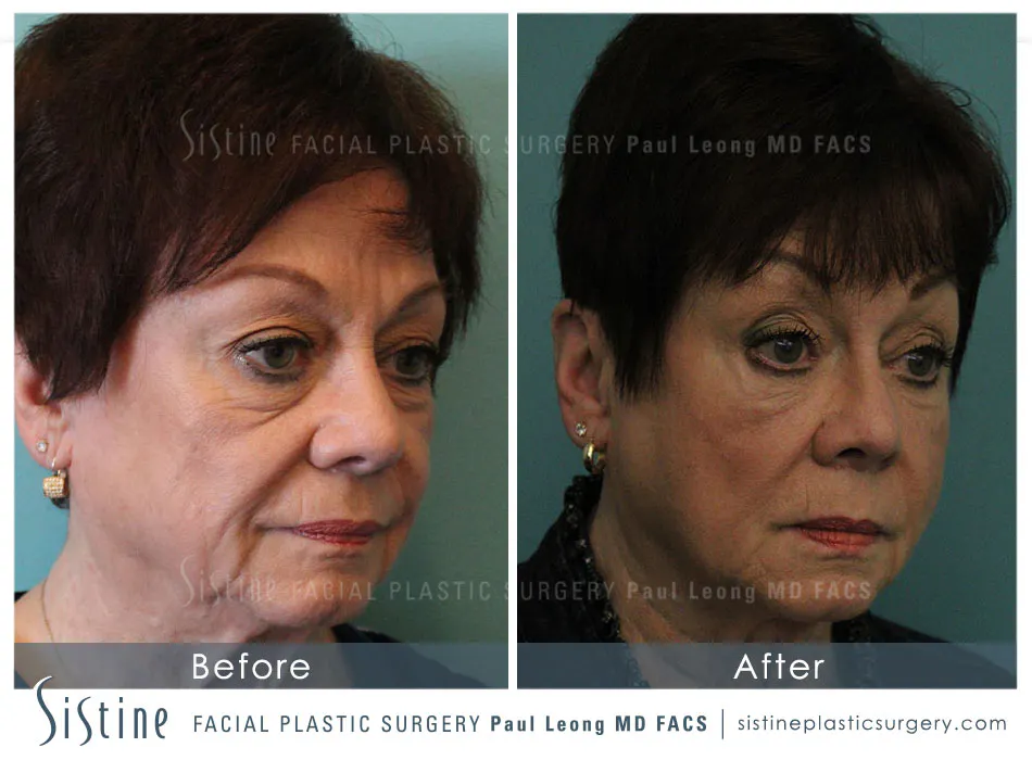 Tear Trough Correction Before and After | Leong Facial Plastic Surgery