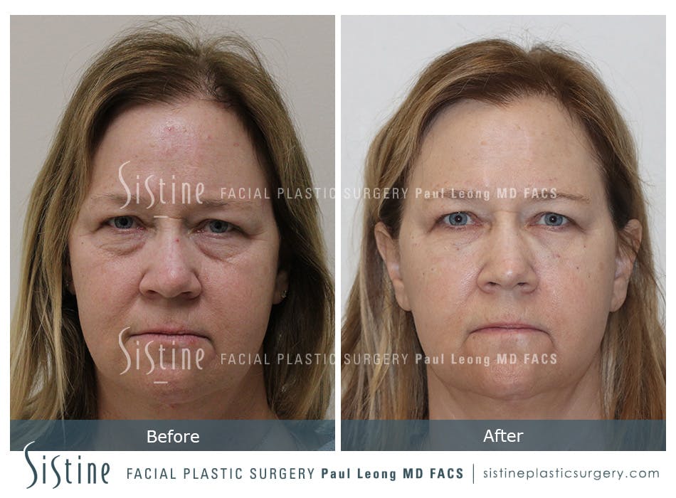Tear Trough Correction Before and After | Leong Facial Plastic Surgery