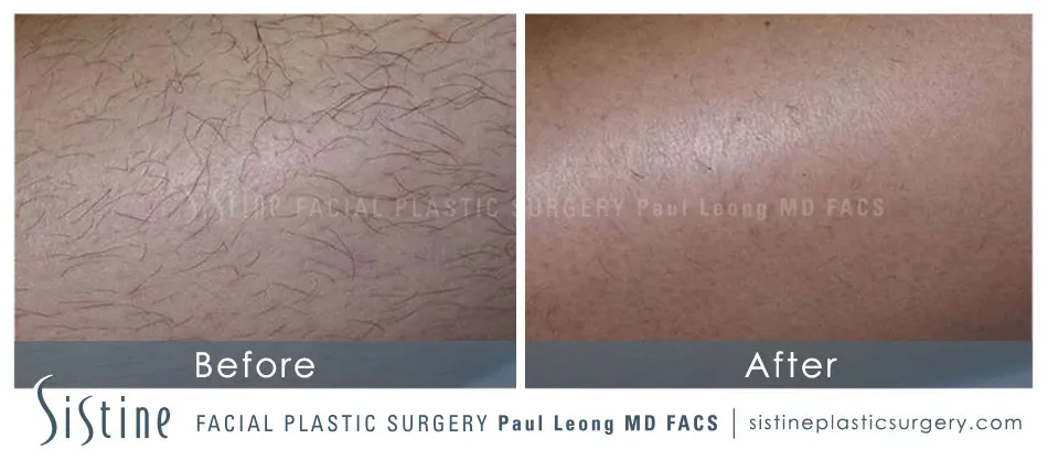 Laser Hair Removal Before and After | Leong Facial Plastic Surgery