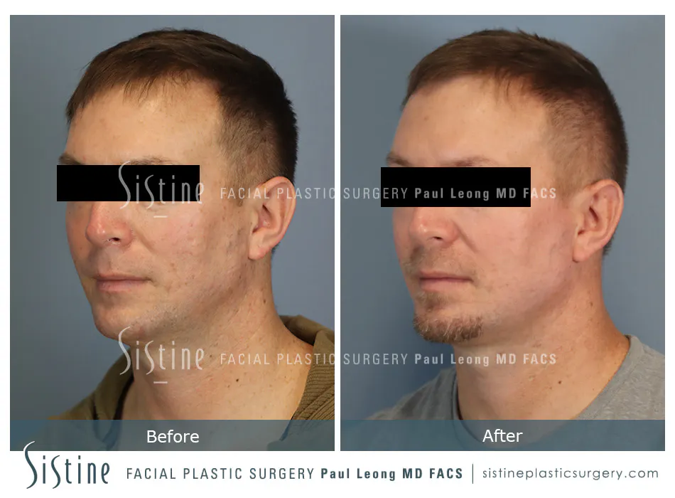 Phoenix Co2 Before and After | Leong Facial Plastic Surgery