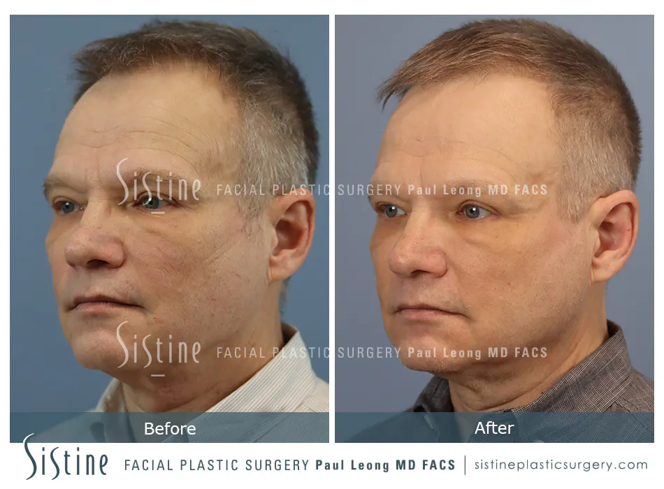 Phoenix Co2 Before and After | Leong Facial Plastic Surgery