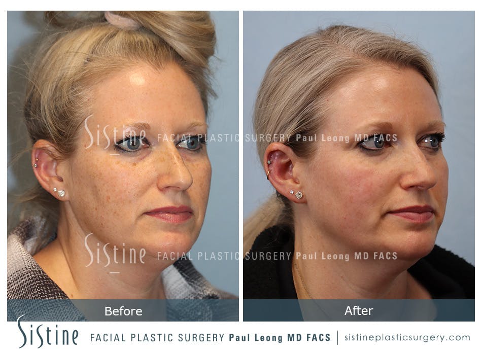 Photofacial Before and After | Leong Facial Plastic Surgery